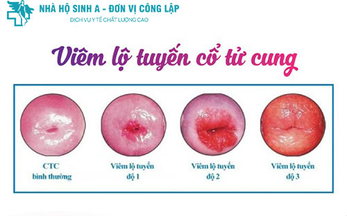 Các cấp độ của bệnh viêm lộ tuyến cổ tử cung