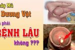 dương vật chảy mủ có phải bệnh lậu không