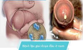Dấu hiệu mắc bệnh lậu ở nam và nữ