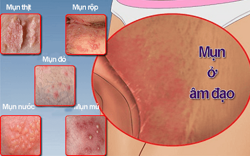 nổi mụn ở âm đạo là bệnh gì?