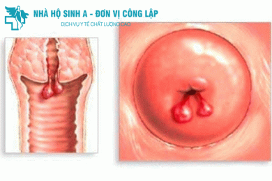 ĐIỂM MẶT 6 DẤU HIỆU POLYP CỔ TỬ CUNG CHỊ EM CẦN BIẾT