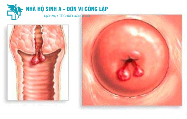 ĐIỂM MẶT 6 DẤU HIỆU POLYP CỔ TỬ CUNG CHỊ EM CẦN BIẾT