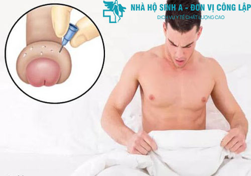 SƯNG BAO QUY ĐẦU KHÁM VÀ ĐIỀU TRỊ KHỎI CÙNG CHUYÊN GIA
