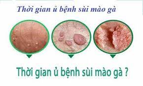 thời gian ủ bệnh của sùi mào gà