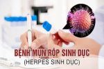 xét nghiệm mụn rộp sinh dục