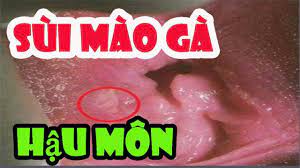 sùi mào gà hậu môn