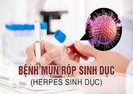 xét nghiệm mụn rộp sinh dục