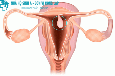 TRIỆU CHỨNG POLYP CỔ TỬ CUNG?