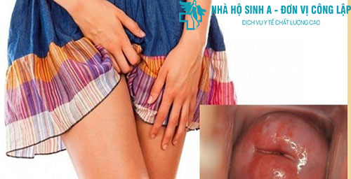 [Chuyên gia chia sẻ] Cách nhận biết triệu chứng viêm lộ tuyến cổ tử cung 