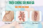 BIỂU HIỆN SÙI MÀO GÀ