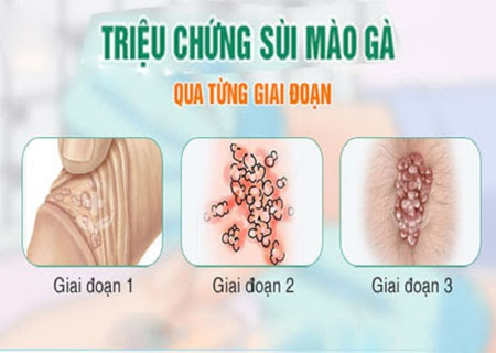 BIỂU HIỆN SÙI MÀO GÀ