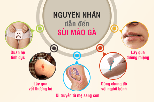 nguyên nhân sùi mào gà ở nữ