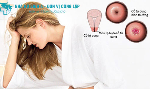 Nguy hiểm khi mắc viêm lộ tuyến cổ tử cung