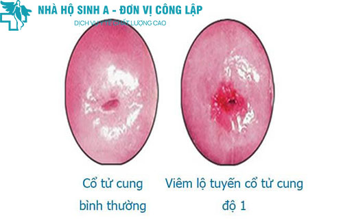 Viêm lộ tuyến cổ tử cung độ 1